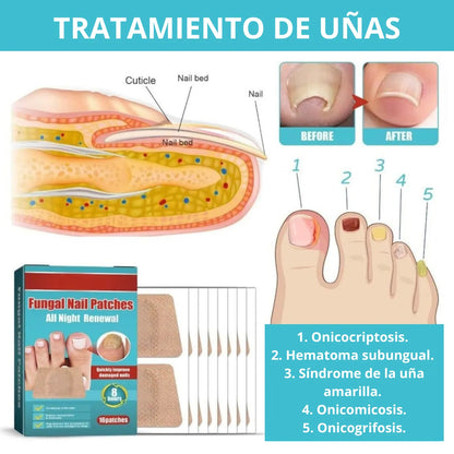 NailRenew™ Parche Antihongos - 48 unidades (Lleva 3 Paga 1)